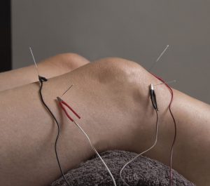 Electro-needling knee injury