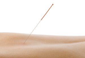 Dry Needling