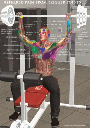 Trigger Point Pain Poster 3 Myotherapy Bayside